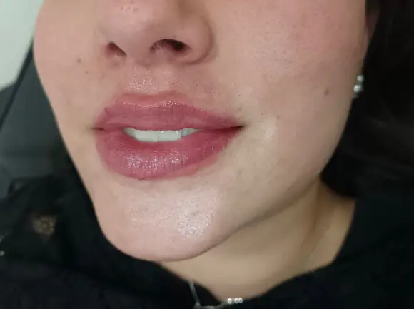 russian-lips.3-despues